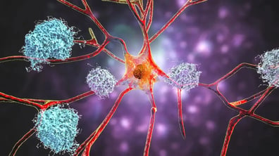 Origen multifactorial de los trastornos del sueño en enfermedad de Parkinson